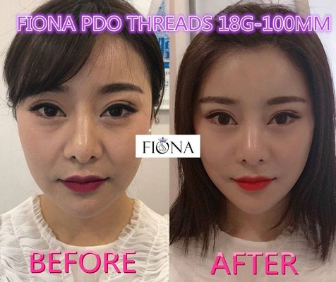 Fiona PDO And PCL Thread , 38mm Face Lift PDO Thread