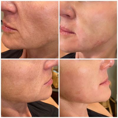 Absorbable  PDO & PCL 19G Mesh Thread for  Deep Wrinkles filling