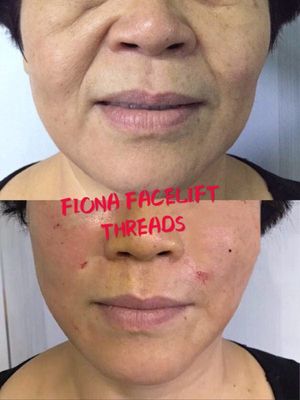 Absorbable  PDO & PCL 19G Mesh Thread for  Deep Wrinkles filling