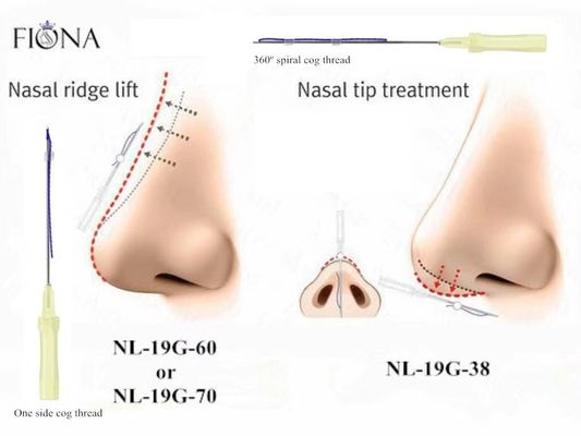 Fiona Nose Lifting Filling Pdo Nose Thread Absorbable With Blunt Cannula