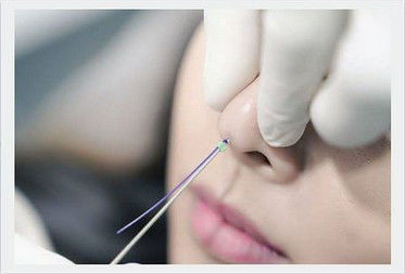 Fiona Nose Lifting Filling Pdo Nose Thread Absorbable With Blunt Cannula