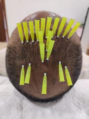 Wrinkles Removal Twist PDO Threads , Eyebrow Lift With PDO Threads
