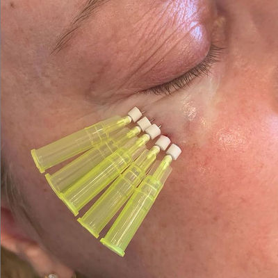 Wrinkles Removal Twist PDO Threads , Eyebrow Lift With PDO Threads