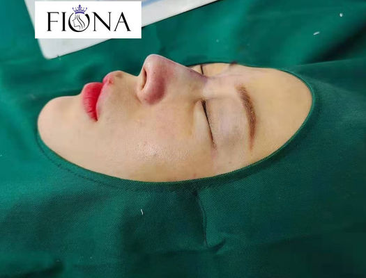 Non Surgical Nose 38mm Absorbable Thread Lift Polydioxanone Pdo