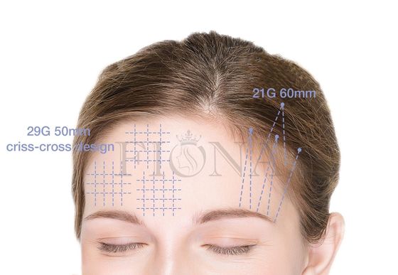PLACL PCL PDO Cog Threads / Barbed Threads For Foxy Eye Ponytail Lifting 360 4D 6D 12D