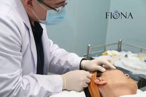 Non-surgical face lifting PDO PCL PLACL Cog Thread Face Lift 360 4D 6D 12D W Cannula