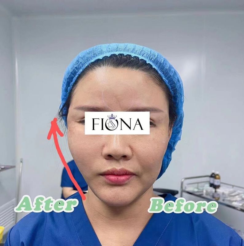 Absorbable PDO Cog Thread Lift EO Gas Sterilized For Eyebrow Lift Fox Eyes