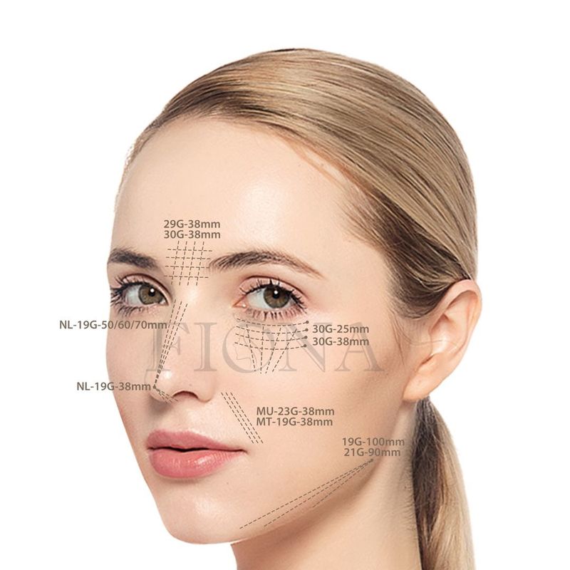30g 25mm Pdo Pcl Absorbable Thread Lift W Type Blunt Cannula For Under Eye Volume Loss